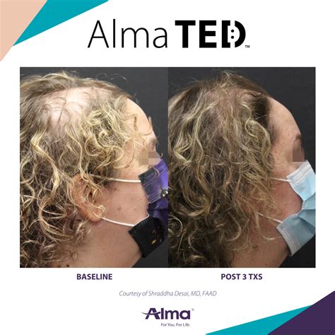 This specialized product is designed to work with the Alma Ted and optimize hair growth,. . Alma ted hair reviews
